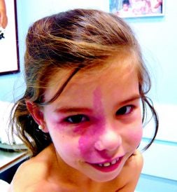 Una niña con angioma en la cara./