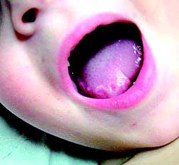 Boca de un niño con estomatitis./