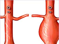 el aneurisma de aorta es hereditario